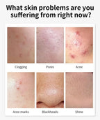 Salicylic Acid Acne Treatment Face Cream Repair Pimple Spots Deep Cleaning Pore Anti-acne Scar Oil Control Moisturizer Skin Care